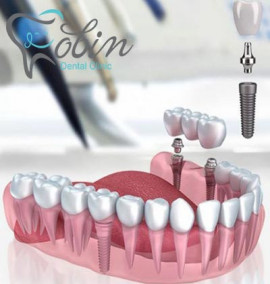 مراقبت‌های قبل و بعد از انجام ایمپلنت دندان، مهم‌تر از جراحی
